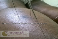 Chennai Jayanth Acupuncture Clinic